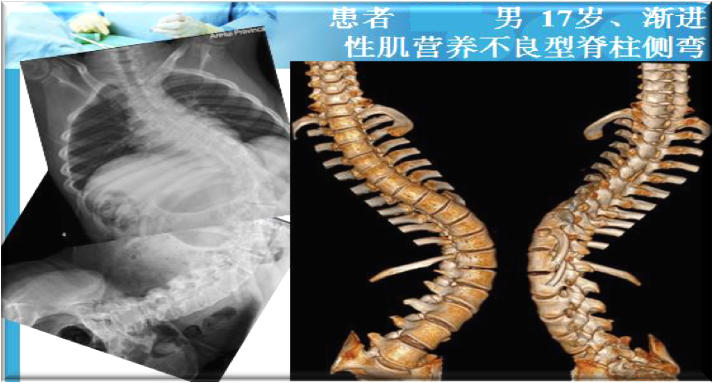 上海數造攜手安徽省二院骨三科專家章玉冰主任 開展3D打印醫療骨科應用在線講堂